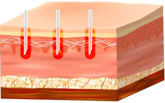 Radiofrequency Energy