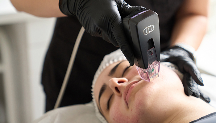 RF Microneedling